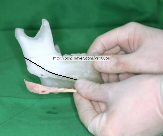 3D 프린팅 모델과 실제 우측 하악각 절제 골편 비교