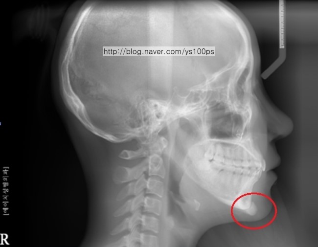 사각턱 재수술과 3D Fit 턱끝 재건 후 측면 X-ray