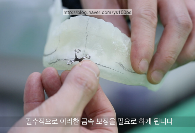턱끝 전진술 후 플레이트로 고정한 3D 모델