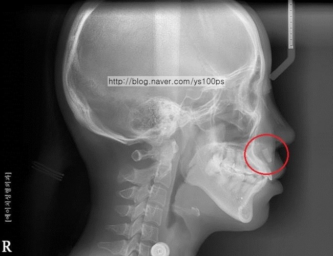 귀족수술과 고양이수술 후 측면 X-ray