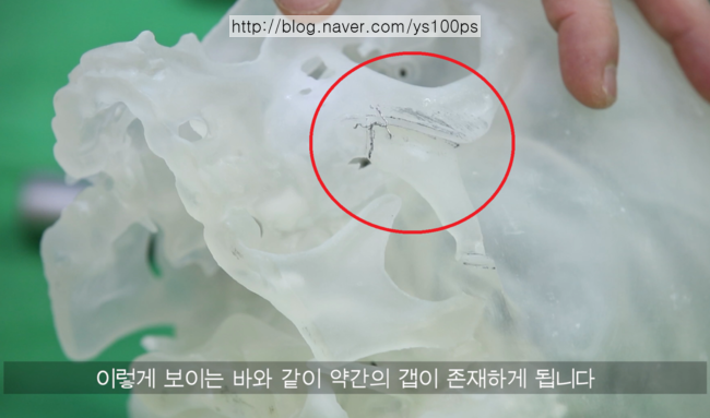 광대축소술 후 체부 계단현상이 생기는 위치