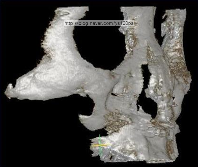 상악 지지대 골 결손이 남은 광대 3D CT