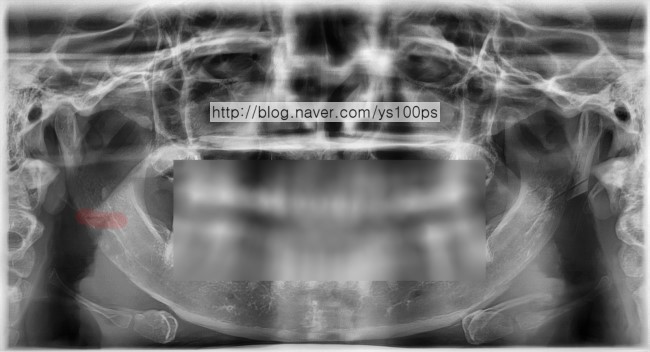 우측 피질골 절골선을 표시한 정면 X-ray
