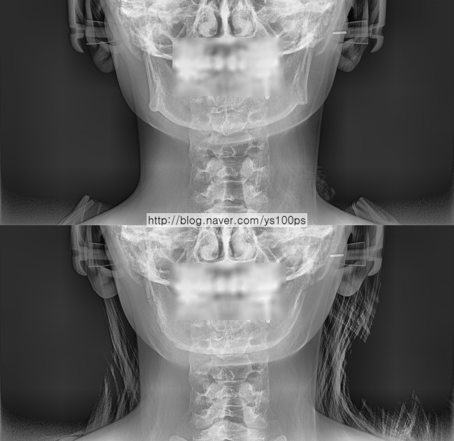 사각턱수술 전후 정면 X-ray