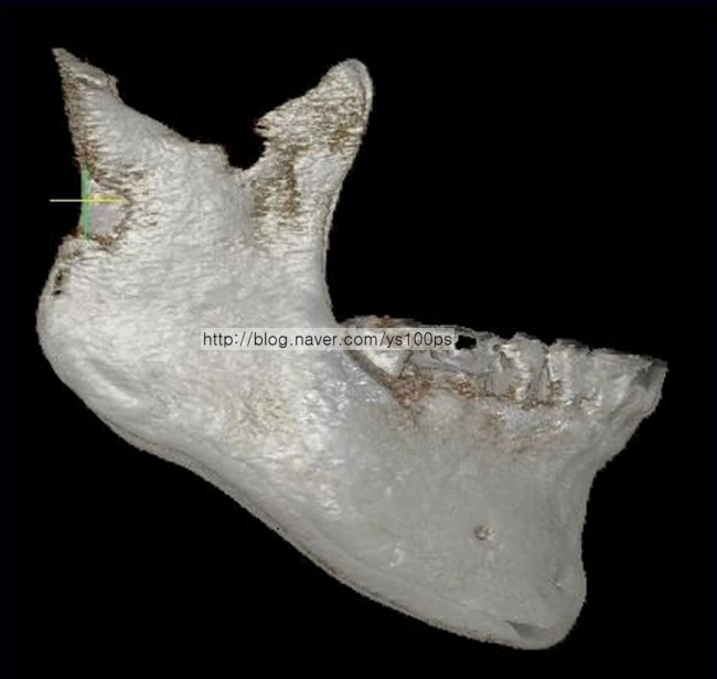 무턱의 턱끝 돌출 부족을 보여주는 3D CT