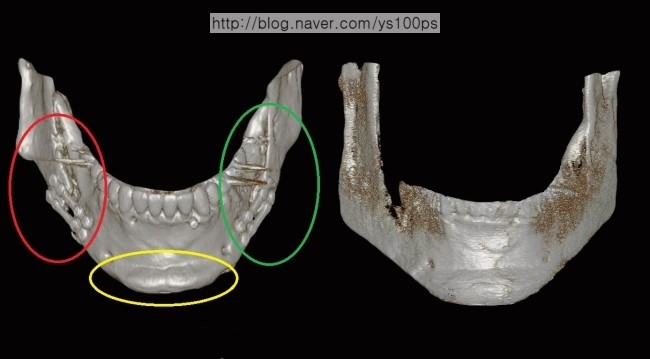 양악수술 후 골 결손과 턱끝 비대칭 재건 전후 정면 3D CT
