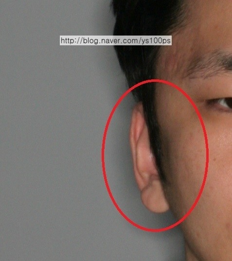 우측 광대 과교정과 측두근 돌출이 보이는 사진