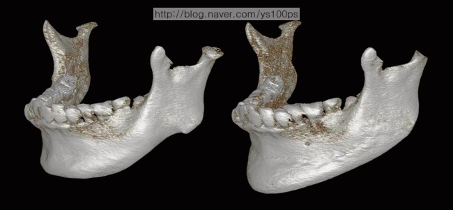 하악왜소증 재건 전후 좌측 사면 3D CT