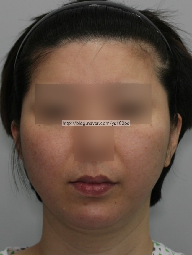 하악왜소증에서 이상적인 하악 재건 형태 정면 도식