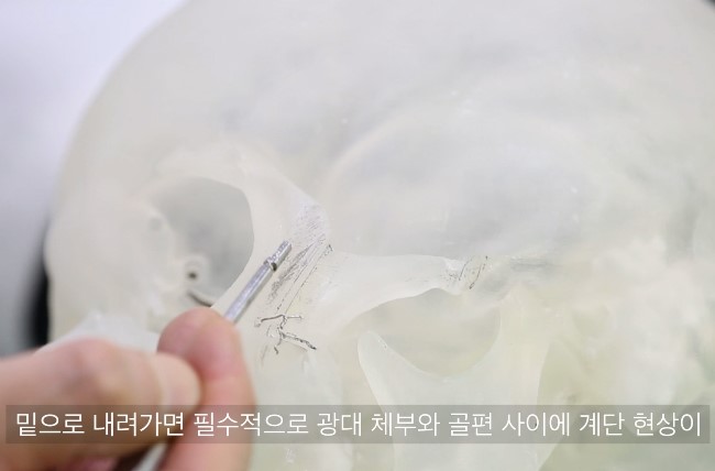 광대 체부 계단현상과 Rasp 교정 부위
