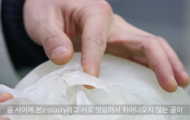 Bone Z-plasty 후 광대아치 계단현상 도식