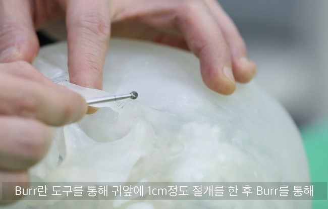 광대아치 계단현상을 Burr로 교정하는 방법