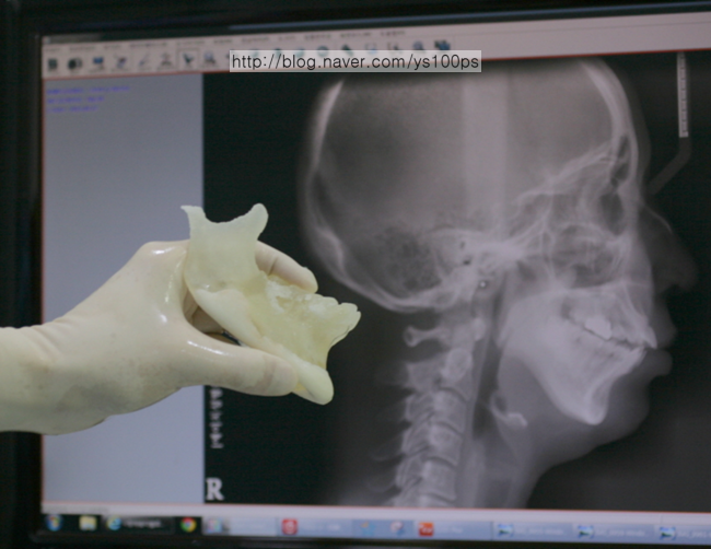 3D 프린팅 하악골 모델과 3D Fit PMMA 보형물
