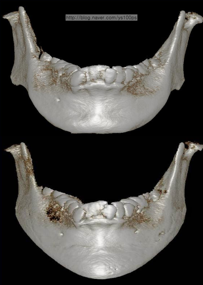 하악왜소증 재건 전후 정면 3D CT