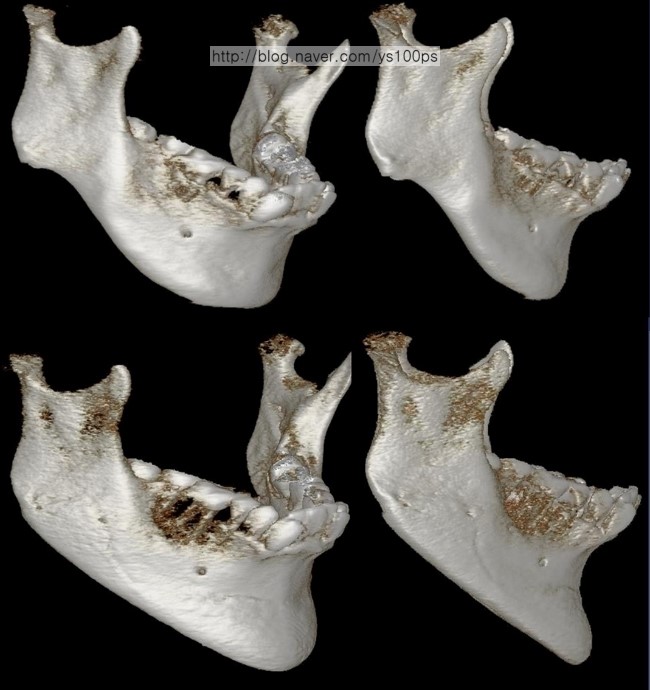 하악왜소증 재건 전후 측면·사면 3D CT