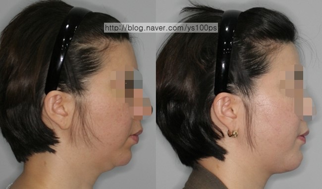 하악왜소증 재건 전후 측면 사진