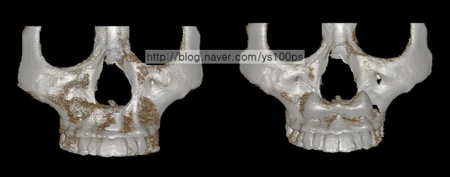 노블캣 재수술 전후 정면 3D CT