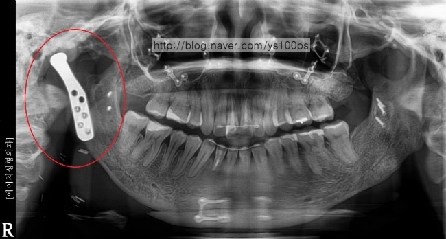 인공 턱관절이 삽입된 하악 파노라마 X-ray