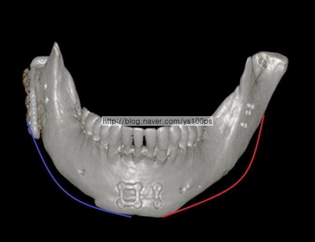 좌우 하악각과 하악체 차이를 보여주는 사면 3D CT
