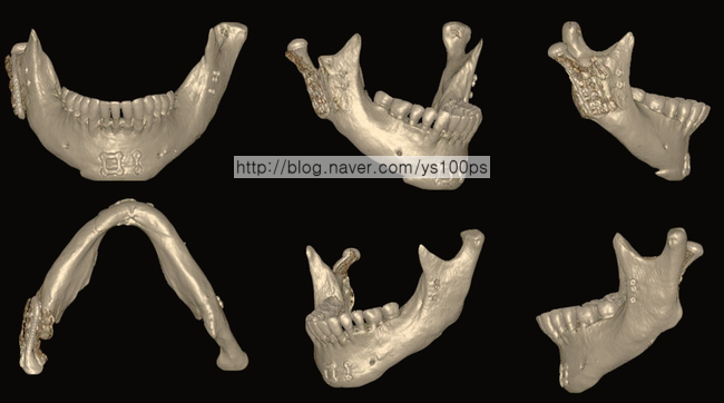 우측 하악 길이 부족과 하악각 결손 정면 3D CT