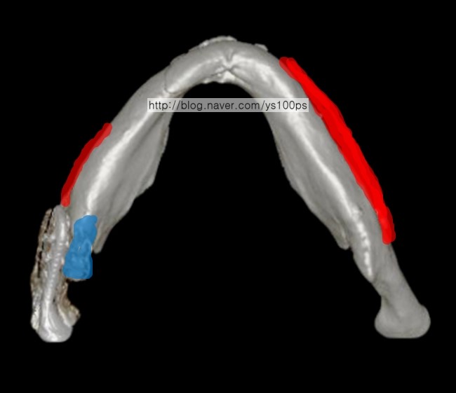 아래에서 본 하악 비대칭 3D CT