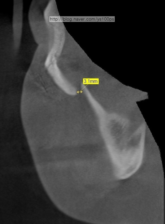 좌측 광대아치 주변 간격을 측정한 단면 CT
