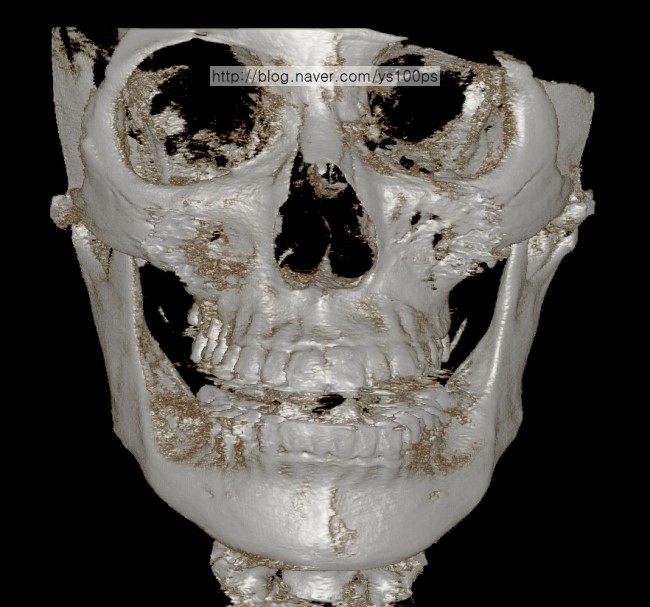 광대축소술 과교정이 의심되는 정면 3D CT