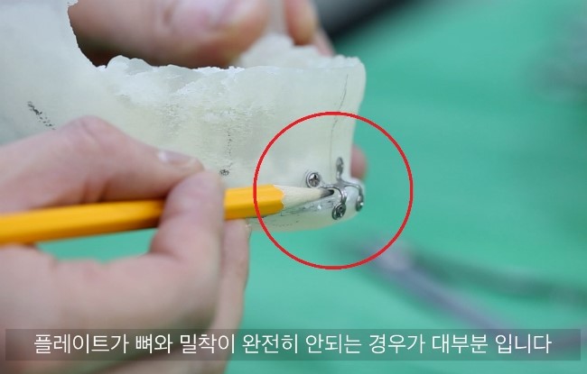 턱끝 골편과 플레이트의 들뜸