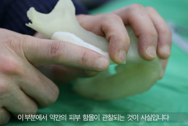 하악각 재건 후 연부조직 부족 부위 표시