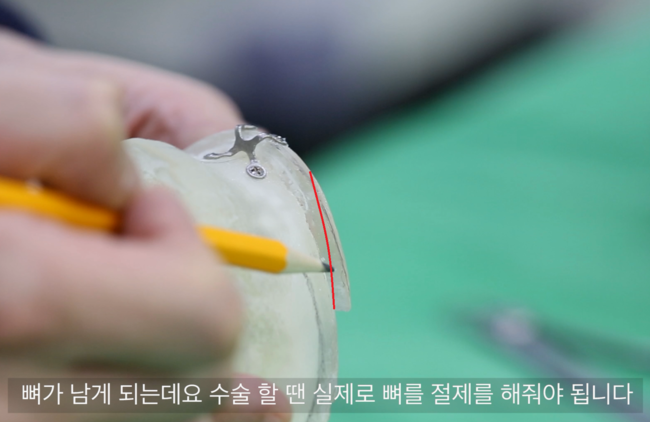 고정 후 남아 있는 턱끝 이차각