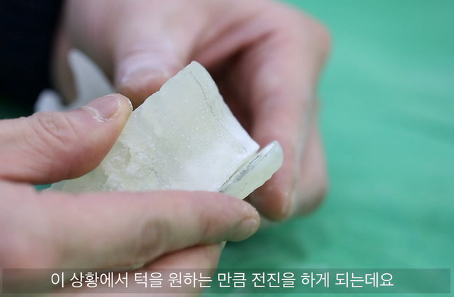 절골한 턱끝 골편을 전진한 3D 모델
