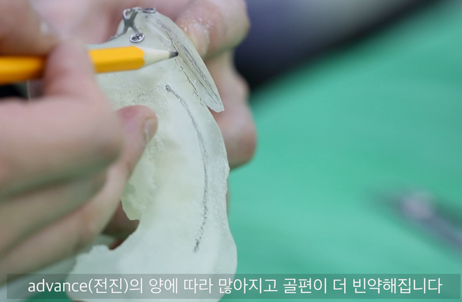 이차각 정리 후 줄어든 턱끝 골편