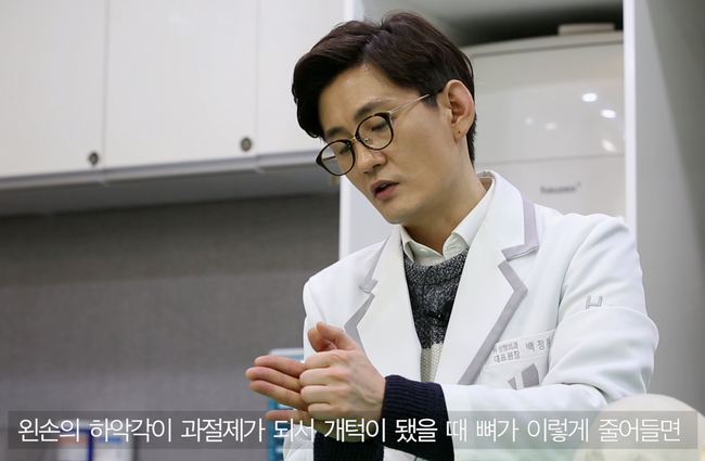 하악각 절제 후 교근 수축을 설명한 모형