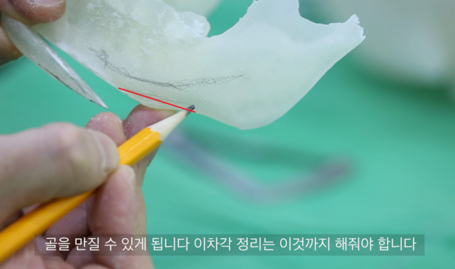 턱끝전진술 후 만져질 수 있는 계단현상