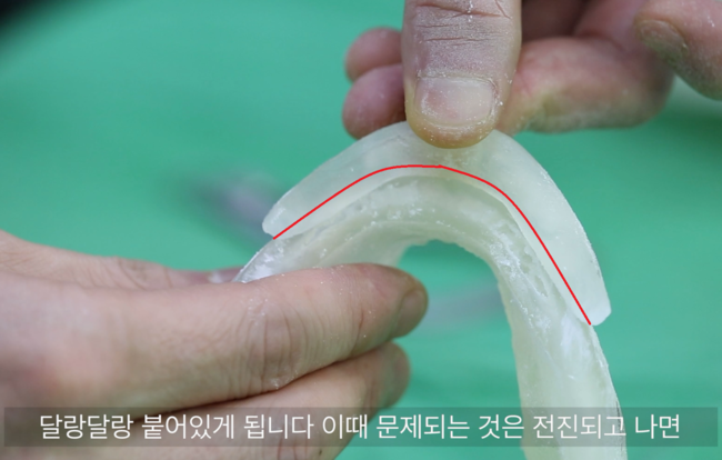 약 8mm 전진한 턱끝 골편의 접촉면