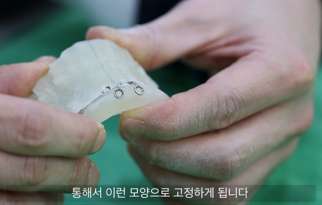 턱끝 골편을 고정하는 플레이트