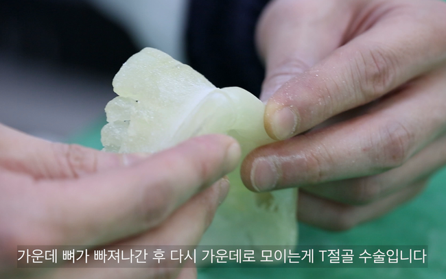 T절골 후 양측 골편을 중앙으로 모은 모습
