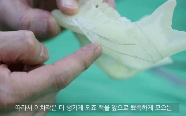 T절골 후 하악체 이차각 모식도