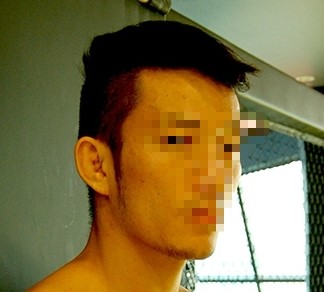 환자가 원한 긴 귀밑각 참고 사진