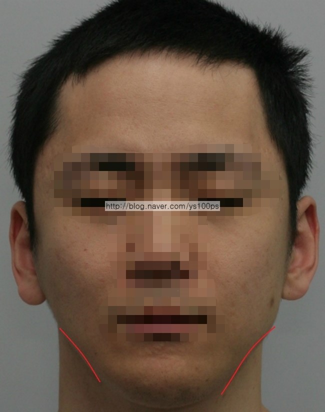 사각턱 과절제 후 정면 얼굴 상태