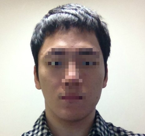 과절제 전 환자의 얼굴 윤곽