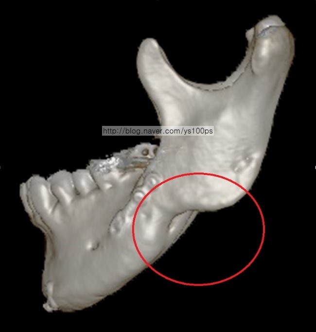 좌측 하악각 과절제 측면 3D CT