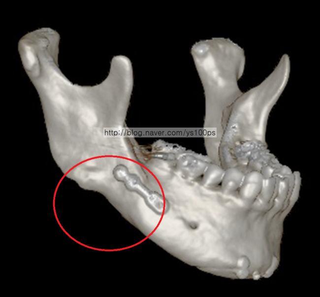 우측 하악체 함몰 사면 3D CT