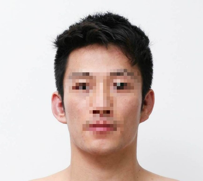 환자가 원한 뚜렷한 하악각 참고 사진