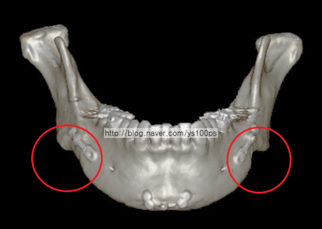 하악체 함몰 정면 3D CT