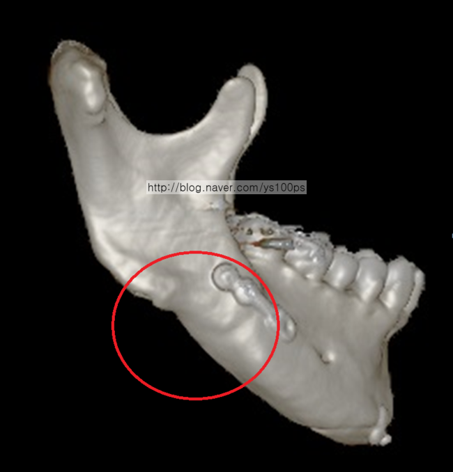 우측 하악각 과절제 측면 3D CT