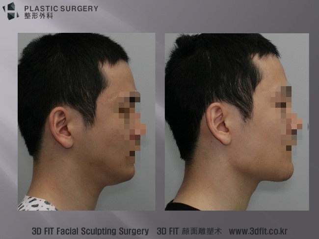사각턱 재건 1주 후 측면 사진