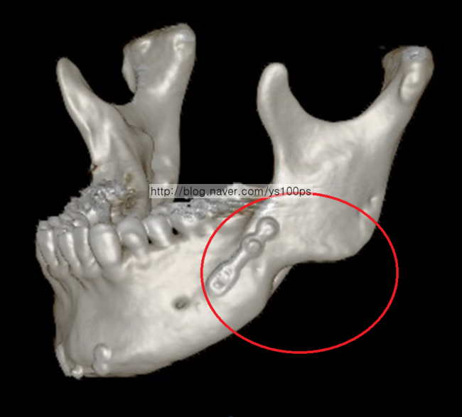 좌측 하악체 함몰 사면 3D CT