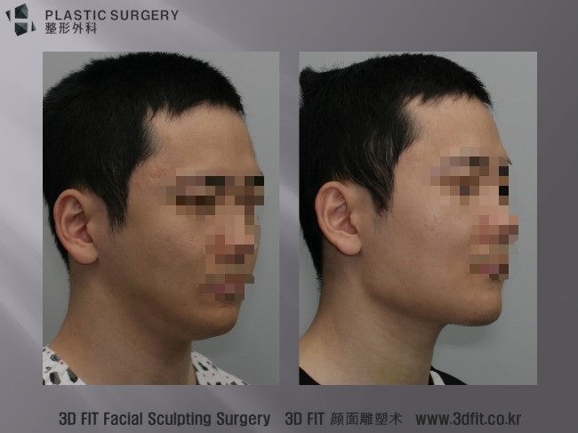 사각턱 재건 1주 후 사면 사진