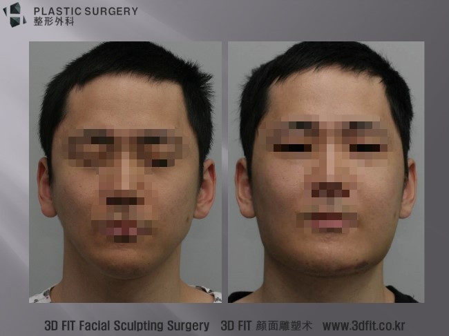 사각턱 재건 1주 후 정면 사진